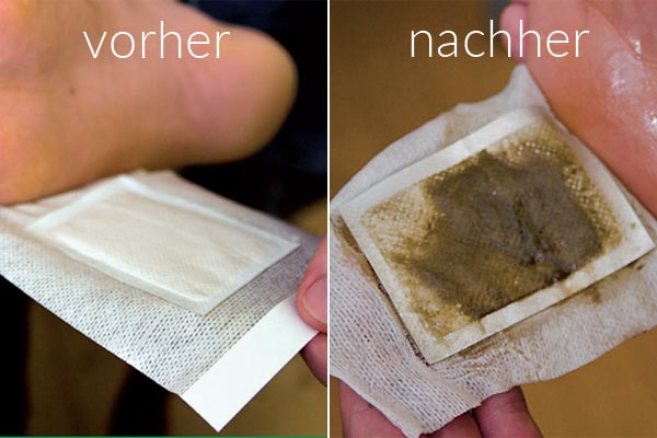 Fußpflaster vorher – nachher